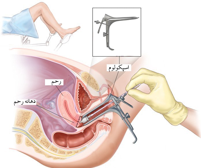 تست پاپ اسمیر چیست و چرا انجام می‌شود؟