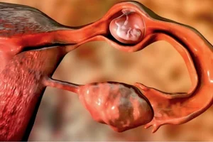 بارداری خارج از رحم | علائم، علل و روشهای درمان