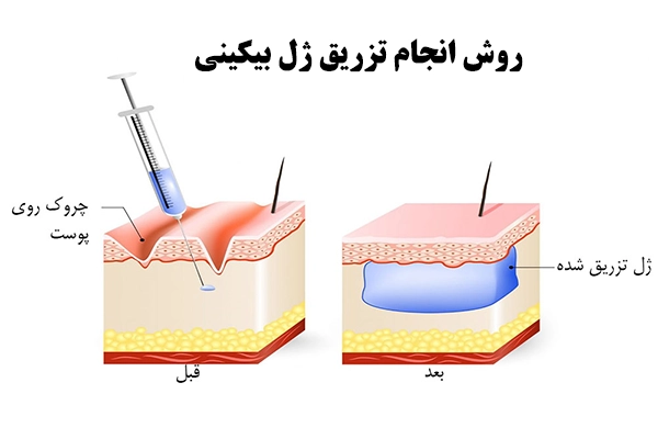روش انجام تزریق ژل بیکینی