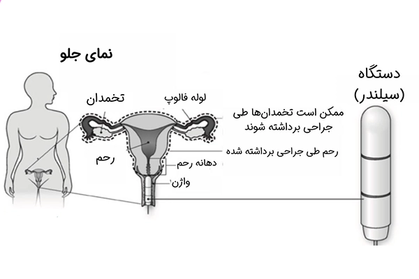 پرتودرمانی (رادیوتراپی)