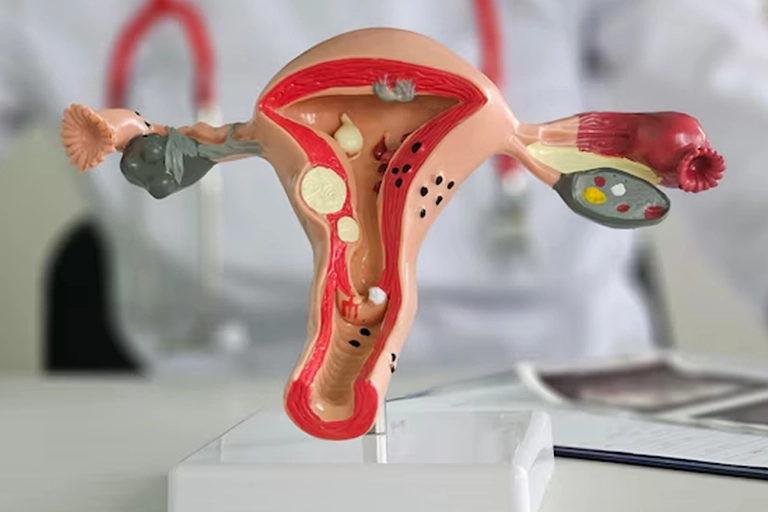 تفسیر نتایج آزمایش کولپوسکوپی