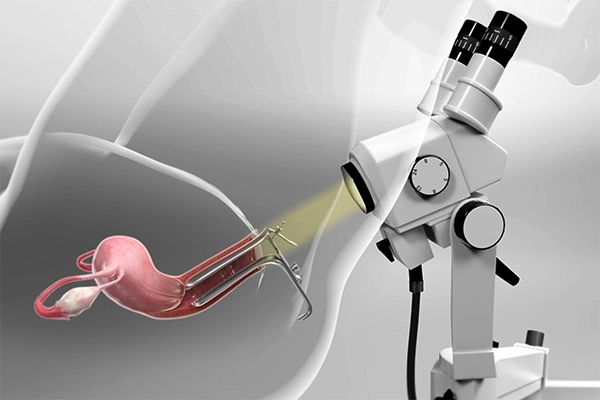 مراحل انجام کولپوسکوپی