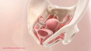 افتادگی رحم و مثانه؛ علائم درجات و درمان